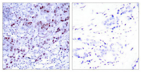 Immunohistochemical analysis of paraffin-embedded human breast carcinoma tissue using GATA1(Ab-142) Antibody(left) or the same antibody preincubated with blocking peptide(right).Rabbit anti-Human GATA1 Polyclonal Antibody