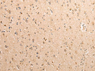 The image on the left is immunohistochemistry of paraffin-embedded Human brain tissue using SDCBP Antibody(SDCBP Antibody) at dilution 1/40, on the right is treated with fusion protein. (Original magnification: ×200)Rabbit anti-Human SDCBP Polyclonal Antibody