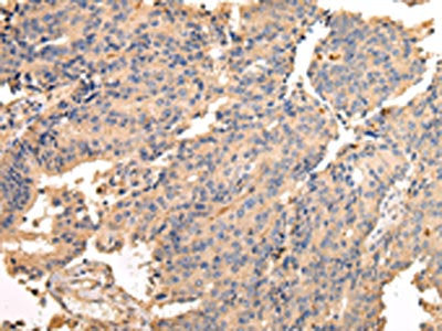 The image on the left is immunohistochemistry of paraffin-embedded Human prostate cancer tissue using the antibody Antibody) at dilution 1/40, on the right is treated with fusion protein. (Original magnification: ×200)Rabbit anti-Human SDCBP Polyclonal Antibody