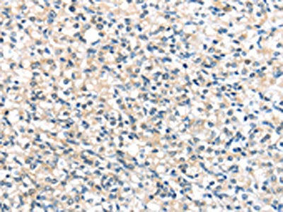 The image on the left is immunohistochemistry of paraffin-embedded Human prostate cancer tissue using UCP3 Antibody(UCP3 Antibody) at dilution 1/20, on the right is treated with synthetic peptide. (Original magnification: ×200)Rabbit anti-Human UCP3 Polyclonal Antibody