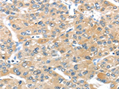 The image on the left is immunohistochemistry of paraffin-embedded Human liver cancer tissue using the antibody Antibody) at dilution 1/20, on the right is treated with synthetic peptide. (Original magnification: ×200)Rabbit anti-Human UCP3 Polyclonal Antibody