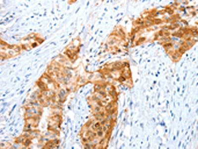 The image on the left is immunohistochemistry of paraffin-embedded Human cervical cancer tissue using ANXA8 Antibody(ANXA8 Antibody) at dilution 1/35, on the right is treated with fusion protein. (Original magnification: ×200)Rabbit anti-Human ANXA8 Polyclonal Antibody
