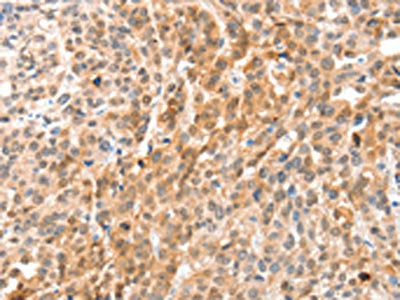 The image on the left is immunohistochemistry of paraffin-embedded Human esophagus cancer tissue using the antibody Antibody) at dilution 1/35, on the right is treated with fusion protein. (Original magnification: ×200)Rabbit anti-Human ANXA8 Polyclonal Antibody