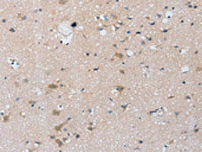 The image on the left is immunohistochemistry of paraffin-embedded Human brain  tissue using PTX3 Antibody(PTX3 Antibody) at dilution 1/25, on the right is treated with synthetic peptide. (Original magnification: ×200)Rabbit anti-Human PTX3 Polyclonal Antibody