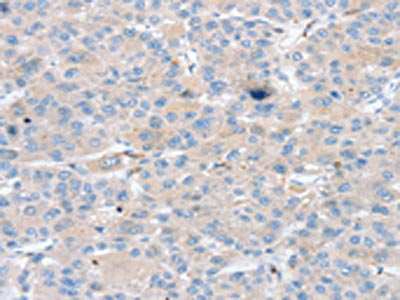 The image on the left is immunohistochemistry of paraffin-embedded Human liver cancer tissue using the antibody Antibody) at dilution 1/25, on the right is treated with synthetic peptide. (Original magnification: ×200)Rabbit anti-Human PTX3 Polyclonal Antibody