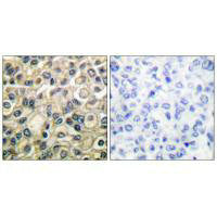 Immunohistochemical analysis of paraffin-embedded human breast carcinoma tissue using Claudin 1 antibody.Rabbit anti-Human CLDN1 Polyclonal Antibody