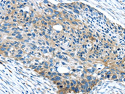 The image on the left is immunohistochemistry of paraffin-embedded Human esophagus cancer tissue using WASF2 Antibody(WASF2 Antibody) at dilution 1/25, on the right is treated with synthetic peptide. (Original magnification: ×200)Rabbit anti-Human WASF2 Polyclonal Antibody