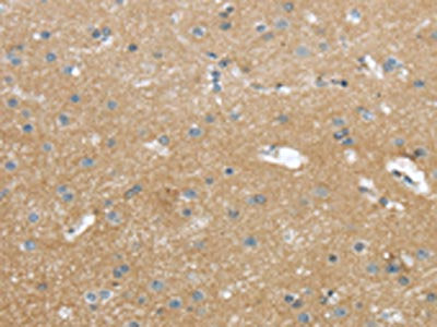 The image on the left is immunohistochemistry of paraffin-embedded Human brain tissue using the antibody Antibody) at dilution 1/25, on the right is treated with synthetic peptide. (Original magnification: ×200)Rabbit anti-Human WASF2 Polyclonal Antibody