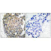 Immunohistochemical analysis of paraffin-embedded human breast carcinoma tissue using keratin 17 antibody.