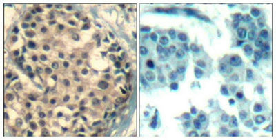 Immunohistochemical analysis of paraffin-embedded human breast carcinoma tissue using HDAC4/HDAC5/HDAC9(Phospho-Ser246/259/220) Antibody(left) or the same antibody preincubated with blocking peptide(right).Rabbit anti-Human HDAC4/HDAC5/HDAC9 Polyclonal Antibody