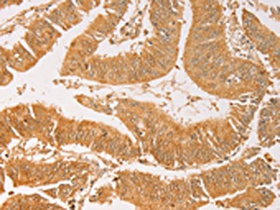 The image on the left is immunohistochemistry of paraffin-embedded Human colon cancer tissue using AK2 Antibody(AK2 Antibody) at dilution 1/40, on the right is treated with fusion protein. (Original magnification: ×200)Rabbit anti-Human AK2 Polyclonal Antibody