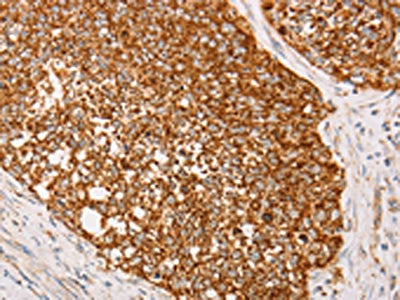 The image on the left is immunohistochemistry of paraffin-embedded Human cervical cancer tissue using the antibody Antibody) at dilution 1/40, on the right is treated with fusion protein. (Original magnification: ×200)Rabbit anti-Human AK2 Polyclonal Antibody