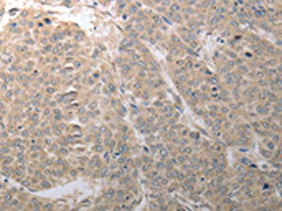 The image on the left is immunohistochemistry of paraffin-embedded Human liver cancer tissue using SLC1A4 Antibody(SLC1A4 Antibody) at dilution 1/70, on the right is treated with synthetic peptide. (Original magnification: ×200)Rabbit anti-Human SLC1A4 Polyclonal Antibody