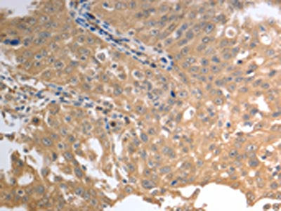 The image on the left is immunohistochemistry of paraffin-embedded Human ovarian cancer tissue using the antibody Antibody) at dilution 1/70, on the right is treated with synthetic peptide. (Original magnification: ×200)Rabbit anti-Human SLC1A4 Polyclonal Antibody