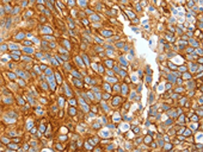 The image on the left is immunohistochemistry of paraffin-embedded Human ovarian cancer tissue using KRT2 Antibody(KRT2 Antibody) at dilution 1/20, on the right is treated with fusion protein. (Original magnification: ×200)