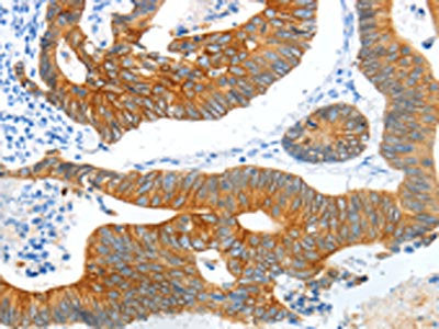The image on the left is immunohistochemistry of paraffin-embedded Human colon cancer tissue using the antibody Antibody) at dilution 1/20, on the right is treated with fusion protein. (Original magnification: ×200)
