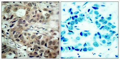 Immunohistochemical analysis of paraffin-embedded human breast carcinoma tissue using cdc25C(Phospho-Ser216) Antibody(left) or the same antibody preincubated with blocking peptide(right).Rabbit anti-Human CDC25C Polyclonal Antibody