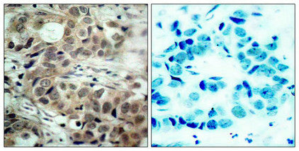 Immunohistochemical analysis of paraffin-embedded human breast carcinoma tissue using cdc25C(Phospho-Ser216) Antibody(left) or the same antibody preincubated with blocking peptide(right).Rabbit anti-Human CDC25C Polyclonal Antibody