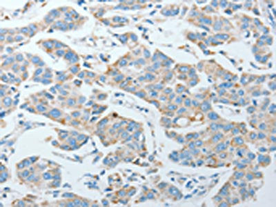 The image on the left is immunohistochemistry of paraffin-embedded Human lung cancer tissue using AGA Antibody(AGA Antibody) at dilution 1/20, on the right is treated with fusion protein. (Original magnification: ×200)Rabbit anti-Human AGA Polyclonal Antibody