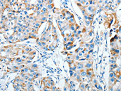 The image on the left is immunohistochemistry of paraffin-embedded Human breast cancer tissue using the antibody Antibody) at dilution 1/20, on the right is treated with fusion protein. (Original magnification: ×200)