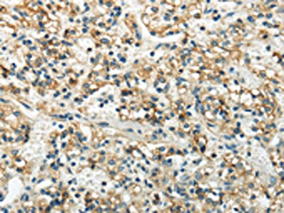 The image on the left is immunohistochemistry of paraffin-embedded Human prostate cancer tissue using WNK3 Antibody(WNK3  Antibody) at dilution 1/20, on the right is treated with synthetic peptide. (Original magnification: ×200)Rabbit anti-Human WNK3 Polyclonal Antibody