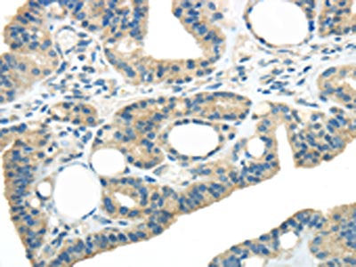 The image on the left is immunohistochemistry of paraffin-embedded Human thyroid cancer tissue using the antibody  Antibody) at dilution 1/20, on the right is treated with synthetic peptide. (Original magnification: ×200)Rabbit anti-Human WNK3 Polyclonal Antibody