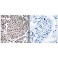 Immunohistochemistry analysis of paraffin-embedded human liver carcinoma tissue using APOL4 antibody.Rabbit anti-Human APOL4 Polyclonal Antibody