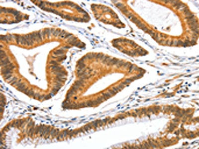 The image on the left is immunohistochemistry of paraffin-embedded Human colon cancer tissue using AIFM3 Antibody(AIFM3 Antibody) at dilution 1/40, on the right is treated with fusion protein. (Original magnification: ×200)Rabbit anti-Human AIFM3 Polyclonal Antibody