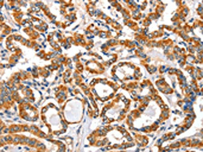 The image on the left is immunohistochemistry of paraffin-embedded Human thyroid cancer tissue using the antibody Antibody) at dilution 1/40, on the right is treated with fusion protein. (Original magnification: ×200)Rabbit anti-Human AIFM3 Polyclonal Antibody