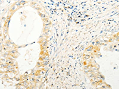 The image on the left is immunohistochemistry of paraffin-embedded Human cervical cancer tissue using TRAF1 Antibody(TRAF1 Antibody) at dilution 1/20, on the right is treated with fusion protein. (Original magnification: ×200)Rabbit anti-Human TRAF1 Polyclonal Antibody