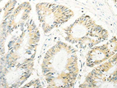 The image on the left is immunohistochemistry of paraffin-embedded Human colon cancer tissue using the antibody Antibody) at dilution 1/20, on the right is treated with fusion protein. (Original magnification: ×200)Rabbit anti-Human TRAF1 Polyclonal Antibody