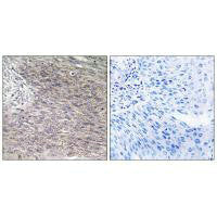 Immunohistochemistry analysis of paraffin-embedded human cervix carcinoma tissue using CHSS2 antibody.