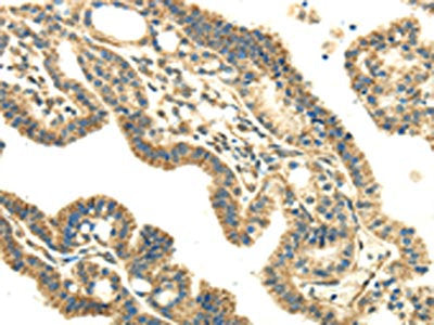 The image on the left is immunohistochemistry of paraffin-embedded Human thyroid cancer tissue using DLAT Antibody(DLAT Antibody) at dilution 1/30, on the right is treated with fusion protein. (Original magnification: ×200)Rabbit anti-Human DLAT Polyclonal Antibody