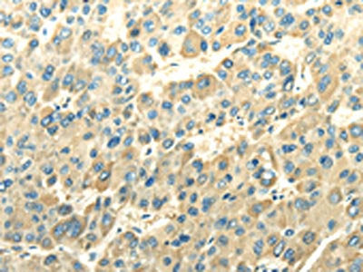 The image on the left is immunohistochemistry of paraffin-embedded Human liver cancer tissue using the antibody Antibody) at dilution 1/30, on the right is treated with fusion protein. (Original magnification: ×200)Rabbit anti-Human DLAT Polyclonal Antibody