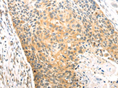 The image on the left is immunohistochemistry of paraffin-embedded Human esophagus cancer tissue using CAPN1 Antibody(CAPN1 Antibody) at dilution 1/20, on the right is treated with fusion protein. (Original magnification: ×200)