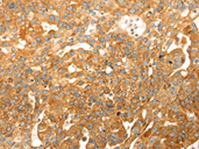 The image on the left is immunohistochemistry of paraffin-embedded Human breast cancer tissue using the antibody Antibody) at dilution 1/20, on the right is treated with fusion protein. (Original magnification: ×200)