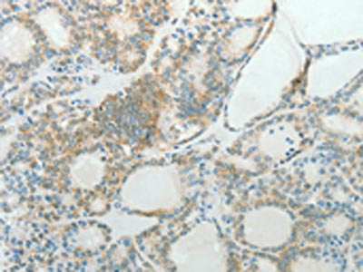 The image on the left is immunohistochemistry of paraffin-embedded Human thyroid cancer tissue using CCND1 Antibody(CCND1 Antibody) at dilution 1/50, on the right is treated with fusion protein. (Original magnification: ×200)Rabbit anti-Human CCND1 Polyclonal Antibody