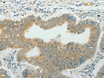 The image on the left is immunohistochemistry of paraffin-embedded Human colon cancer tissue using the antibody Antibody) at dilution 1/50, on the right is treated with fusion protein. (Original magnification: ×200)Rabbit anti-Human CCND1 Polyclonal Antibody