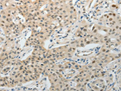 The image on the left is immunohistochemistry of paraffin-embedded Human lung cancer tissue using TFPI2 Antibody(TFPI2 Antibody) at dilution 1/25, on the right is treated with fusion protein. (Original magnification: ×200)Rabbit anti-Human TFPI2 Polyclonal Antibody