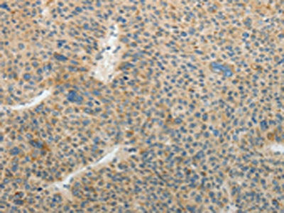The image on the left is immunohistochemistry of paraffin-embedded Human liver cancer  tissue using the antibody Antibody) at dilution 1/25, on the right is treated with fusion protein. (Original magnification: ×200)Rabbit anti-Human TFPI2 Polyclonal Antibody