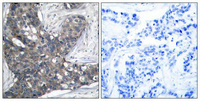 Immunohistochemical analysis of paraffin-embedded human breast carcinoma tissue using eIF2a(Ab-51) Antibody(left) or the same antibody preincubated with blocking peptide(right).Rabbit anti-Human EIF2S1 Polyclonal Antibody