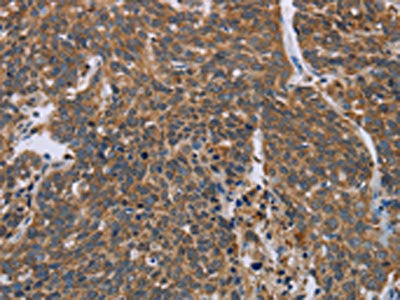 The image on the left is immunohistochemistry of paraffin-embedded Human cervical cancer tissue using HIF1AN Antibody(HIF1AN Antibody) at dilution 1/25, on the right is treated with synthetic peptide. (Original magnification: ×200)Rabbit anti-Human HIF1AN Polyclonal Antibody