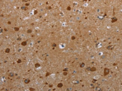The image on the left is immunohistochemistry of paraffin-embedded Human brain tissue using the antibody Antibody) at dilution 1/25, on the right is treated with synthetic peptide. (Original magnification: ×200)Rabbit anti-Human HIF1AN Polyclonal Antibody