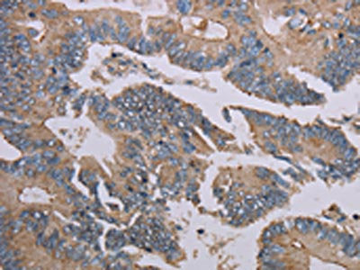 The image on the left is immunohistochemistry of paraffin-embedded Human colon cancer tissue using MMP20 Antibody(MMP20 Antibody) at dilution 1/40, on the right is treated with synthetic peptide. (Original magnification: ×200)Rabbit anti-Human MMP20 Polyclonal Antibody