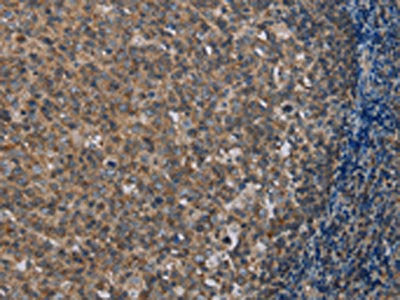 The image on the left is immunohistochemistry of paraffin-embedded Human tonsil tissue using the antibody Antibody) at dilution 1/40, on the right is treated with synthetic peptide. (Original magnification: ×200)
