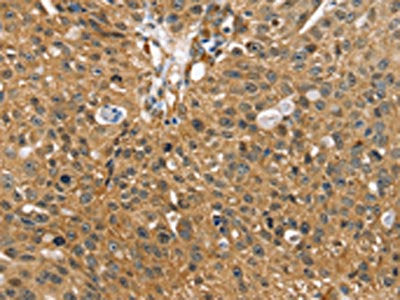 The image on the left is immunohistochemistry of paraffin-embedded Human breast cancer tissue using SORT1 Antibody(SORT1 Antibody) at dilution 1/35, on the right is treated with synthetic peptide. (Original magnification: ×200)Rabbit anti-Human SORT1 Polyclonal Antibody