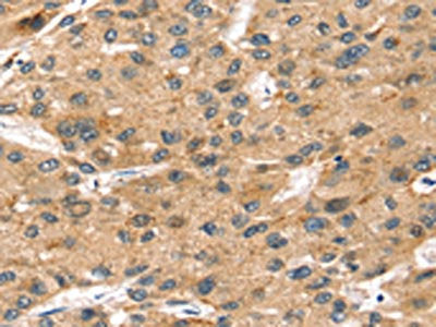 The image on the left is immunohistochemistry of paraffin-embedded Human liver cancer tissue using the antibody Antibody) at dilution 1/35, on the right is treated with synthetic peptide. (Original magnification: ×200)Rabbit anti-Human SORT1 Polyclonal Antibody
