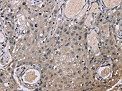 The image on the left is immunohistochemistry of paraffin-embedded Human esophagus cancer tissue using EID1 Antibody(EID1 Antibody) at dilution 1/20, on the right is treated with fusion protein. (Original magnification: ×200)Rabbit anti-Human EID1 Polyclonal Antibody