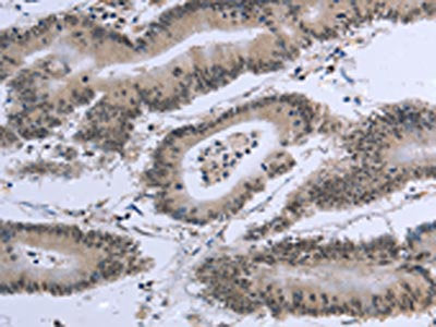 The image on the left is immunohistochemistry of paraffin-embedded Human colon cancer tissue using the antibody Antibody) at dilution 1/20, on the right is treated with fusion protein. (Original magnification: ×200)Rabbit anti-Human EID1 Polyclonal Antibody