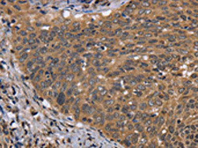 The image on the left is immunohistochemistry of paraffin-embedded Human cervical cancer tissue using FGFR1OP Antibody(FGFR1OP Antibody) at dilution 1/40, on the right is treated with fusion protein. (Original magnification: ×200)Rabbit anti-Human FGFR1OP Polyclonal Antibody